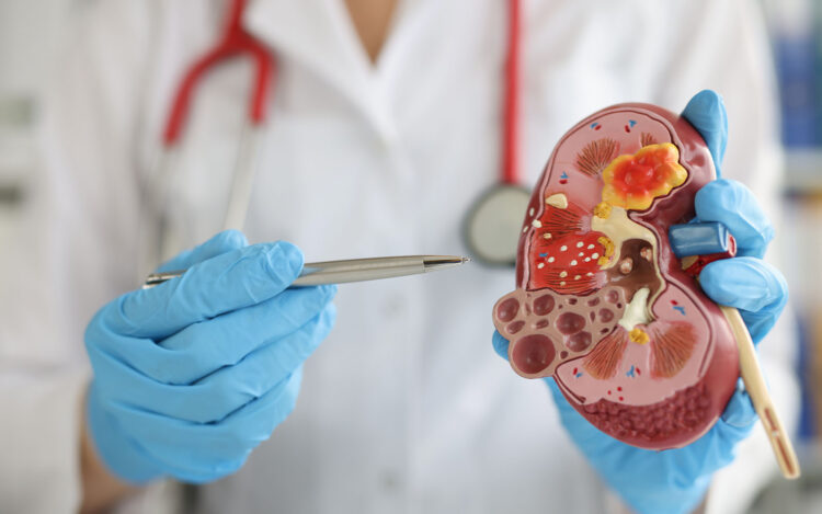 Jangan Abaikan 8 Gejala Batu Ginjal, Termasuk Nyeri di Bagian Tubuh Ini